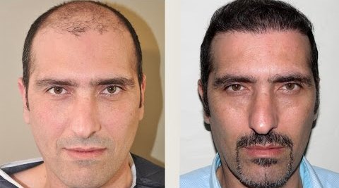 Best Hair Transplant in Turkey 19