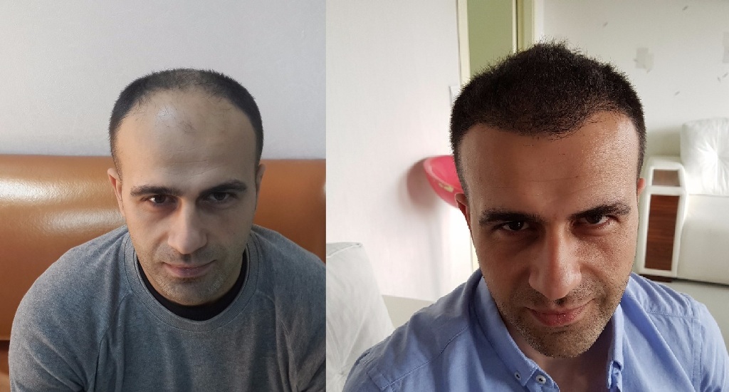 Best Hair Transplant in Turkey 21