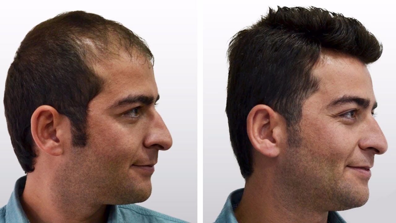Best Hair Transplant in Turkey 9